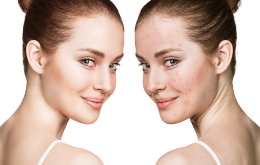 MACA...NATURAL WAY TO GET RID OF ACNE!